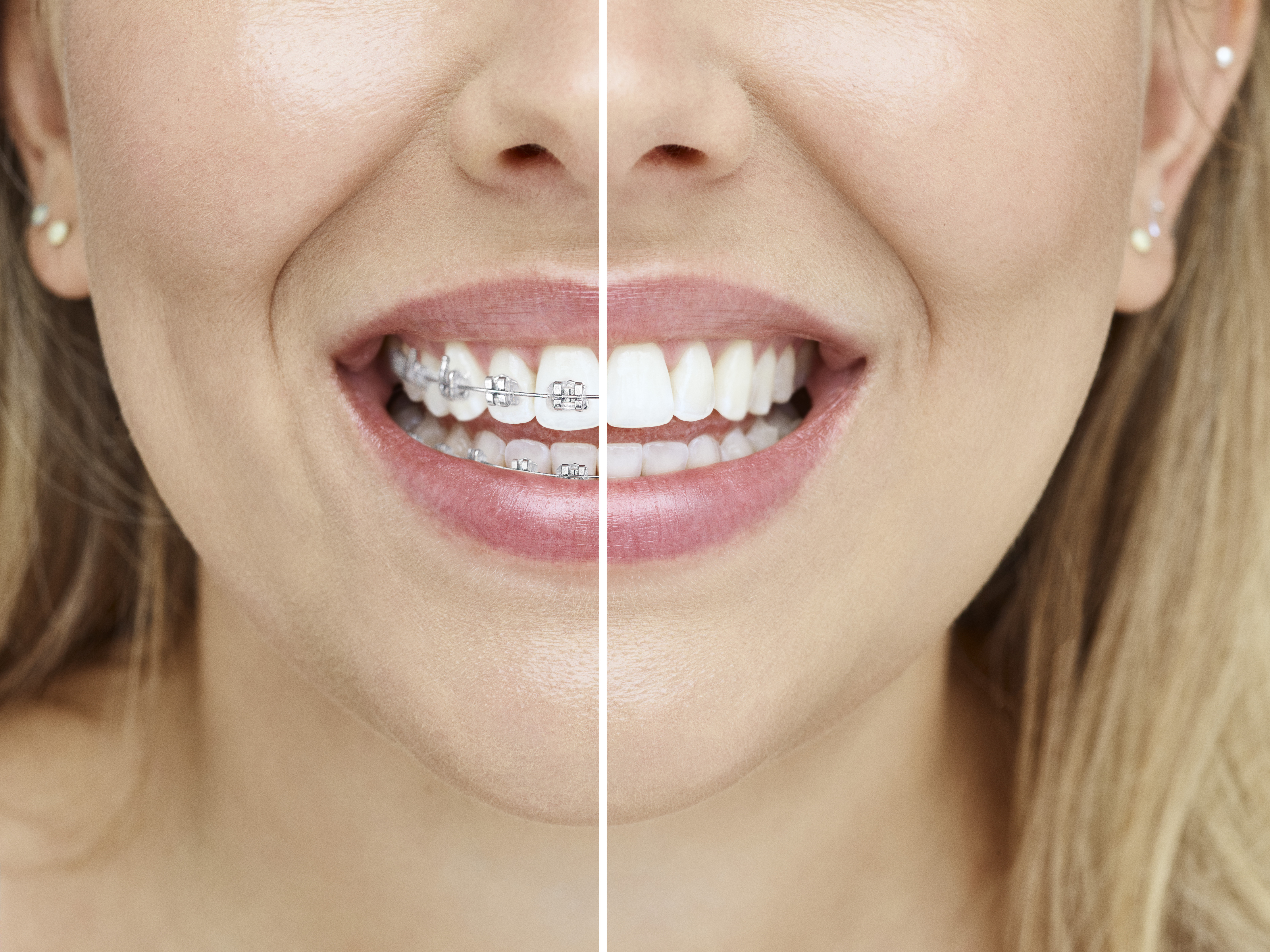 Braces Melbourne — The Smile Designer